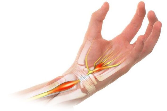 Pain caused by arthritis