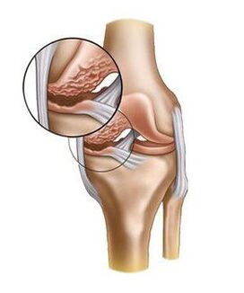 The cartilage is damaged