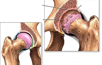 Diagnosis of hip arthritis