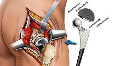 Endoprosthetic for hip arthritis