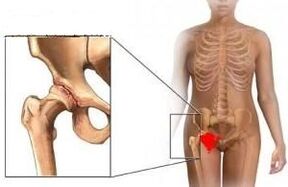 Reasons for the development of joints of the hip joint