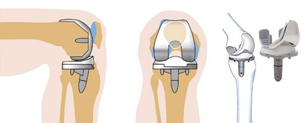 Hormonal activities of knee joints for arthritis