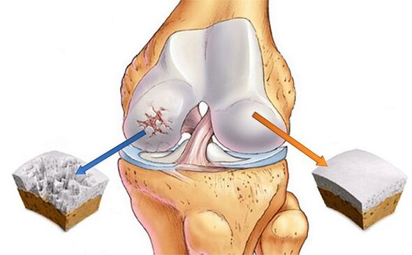 Standard and deviation for knee joint disease
