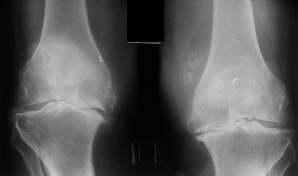 X -ray as a knee joint diagnosis