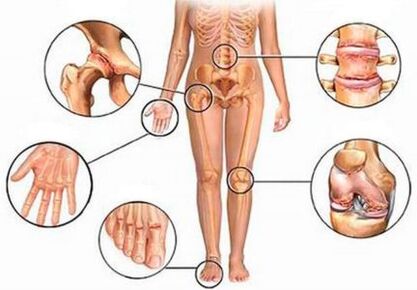 Arthritis and joints of different joints