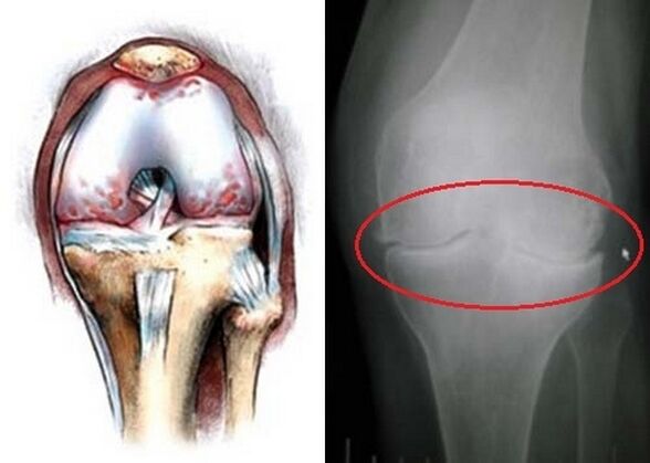 Deformation of knee joints for arthritis
