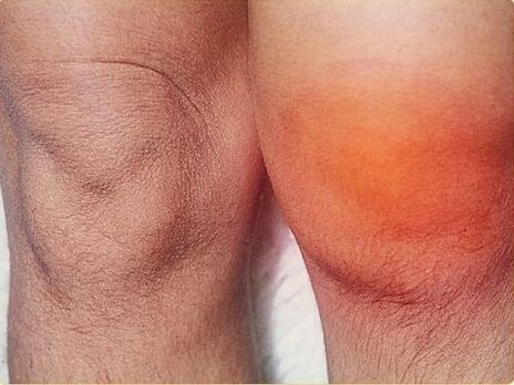 Knee arthritis is affected by arthritis