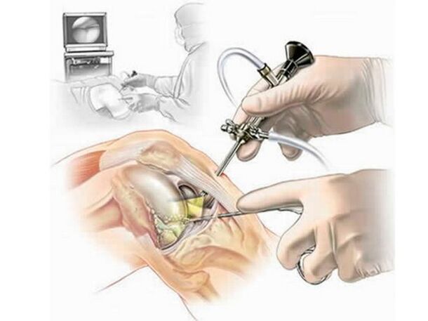 Knee endoscopy