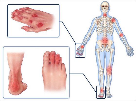 Red skin and swollen arthritis