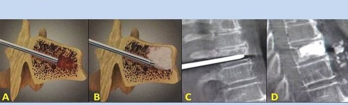 Spine surgery to treat back pain