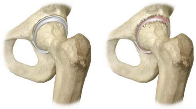 The hip joint is healthy and the head necrosis is the cause of pain