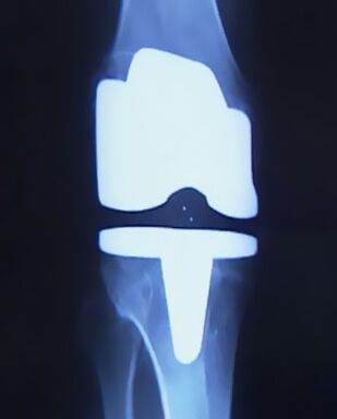 X-ray of knee joint with artificial joint after joint replacement surgery