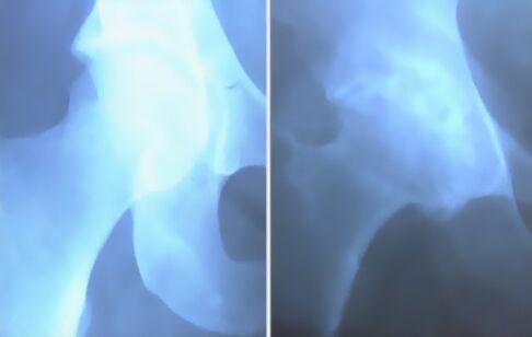image of knee osteoarthritis