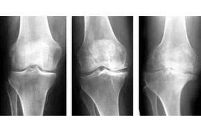 degenerative joint stage on x-ray film