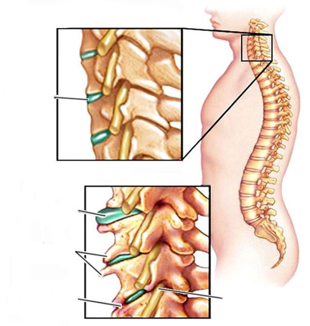 bone necrosis and healthy neck spine